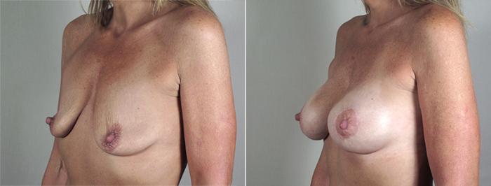 Breast Lift with Implants Case 469 Before & After View #2 | Paramus, New Jersey | Parker Center for Plastic Surgery