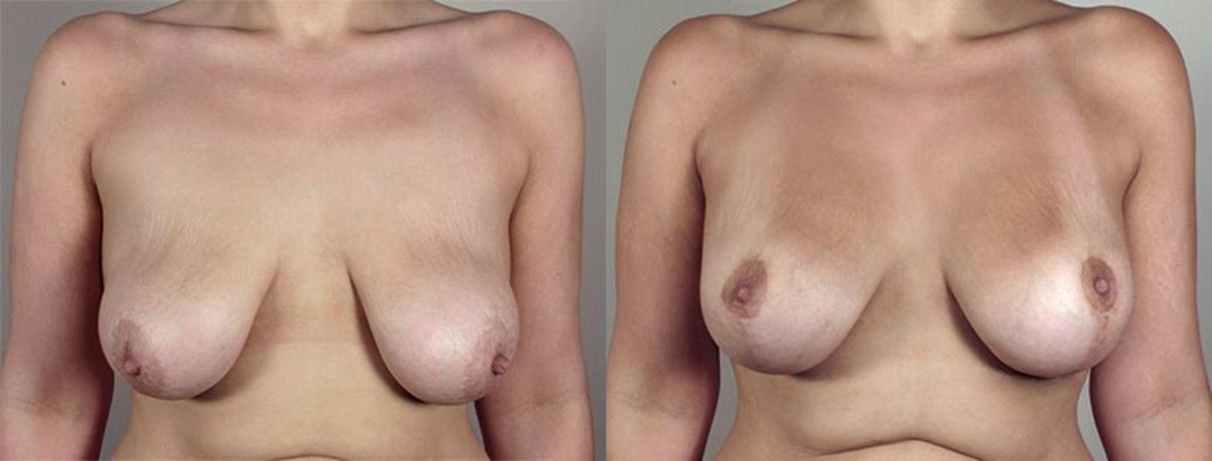 Breast Lift with Implants Case 470 Before & After View #1 | Paramus, New Jersey | Parker Center for Plastic Surgery