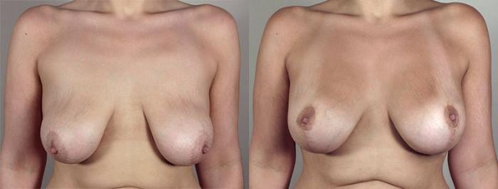 Breast Lift with Implants Case 470 Before & After View #1 | Paramus, New Jersey | Parker Center for Plastic Surgery