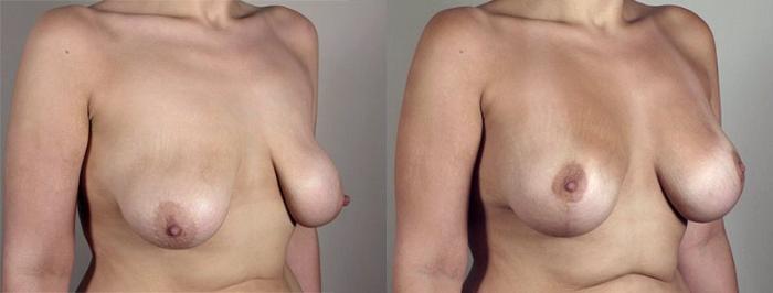 Breast Lift with Implants Case 470 Before & After View #2 | Paramus, New Jersey | Parker Center for Plastic Surgery