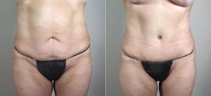Breast Lift with Implants Case 472 Before & After View #3 | Paramus, New Jersey | Parker Center for Plastic Surgery