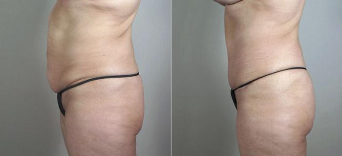 Breast Lift with Implants Case 472 Before & After View #4 | Paramus, New Jersey | Parker Center for Plastic Surgery