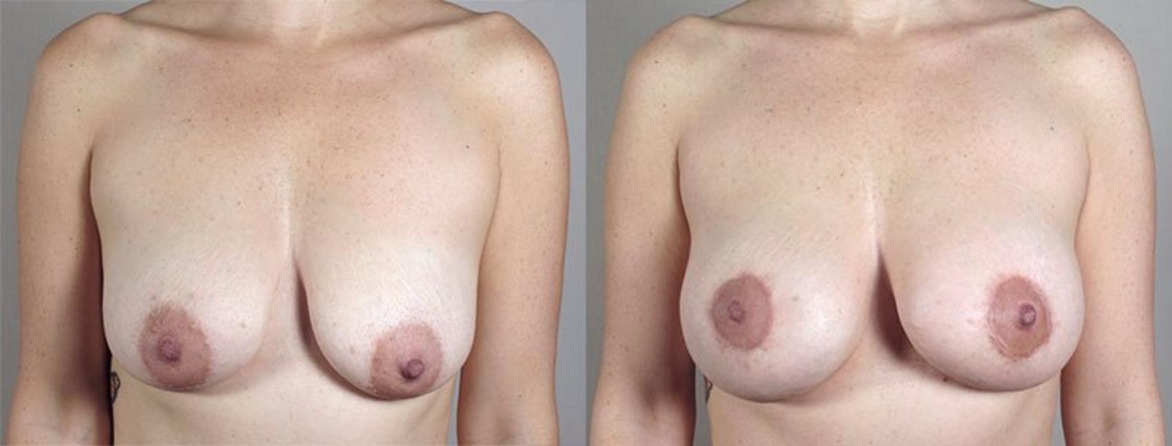 Breast Lift with Implants Case 473 Before & After View #1 | Paramus, New Jersey | Parker Center for Plastic Surgery