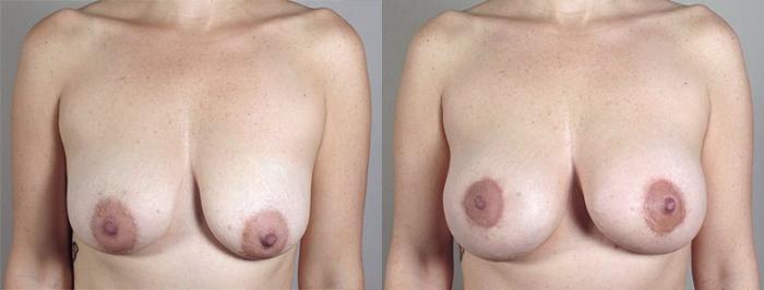 Breast Lift with Implants Case 473 Before & After View #1 | Paramus, New Jersey | Parker Center for Plastic Surgery