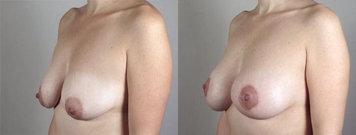 Breast Lift with Implants Case 473 Before & After View #2 | Paramus, New Jersey | Parker Center for Plastic Surgery