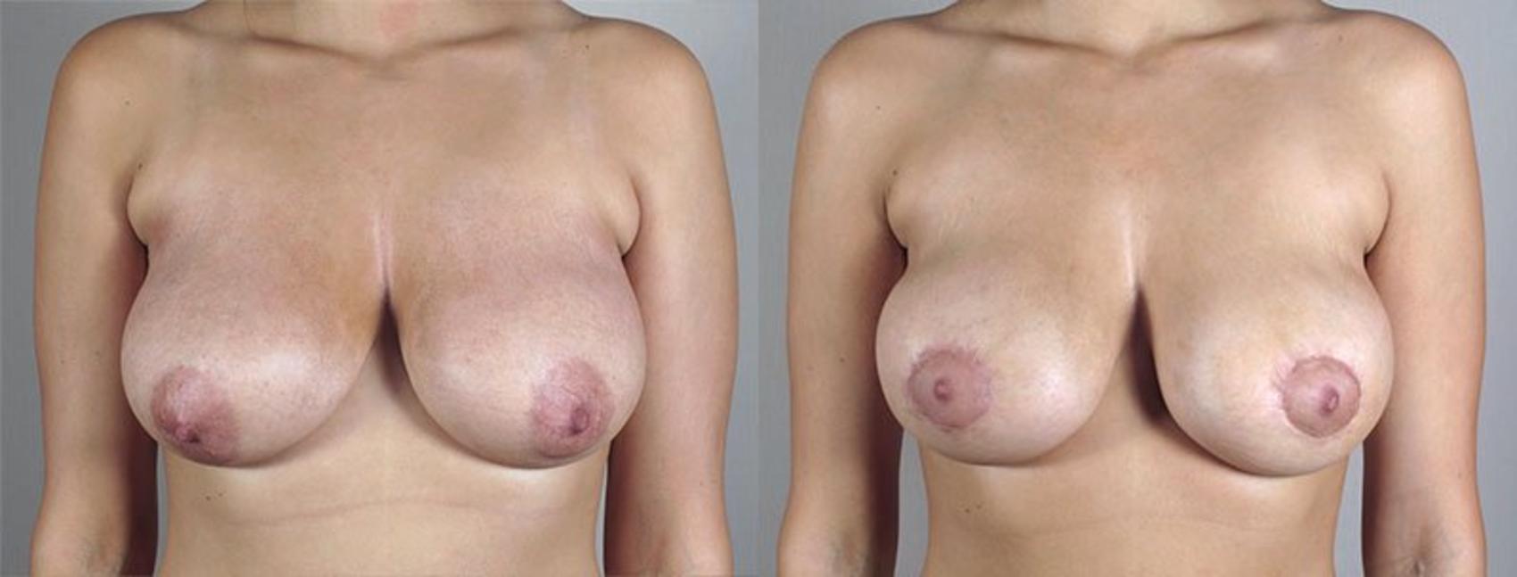Breast Lift with Implants Case 474 Before & After View #1 | Paramus, New Jersey | Parker Center for Plastic Surgery