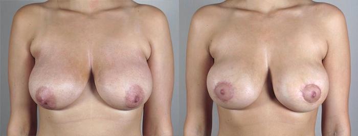 Breast Lift with Implants Case 474 Before & After View #1 | Paramus, New Jersey | Parker Center for Plastic Surgery