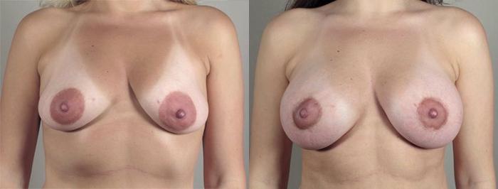 Breast Lift with Implants Case 476 Before & After View #1 | Paramus, New Jersey | Parker Center for Plastic Surgery