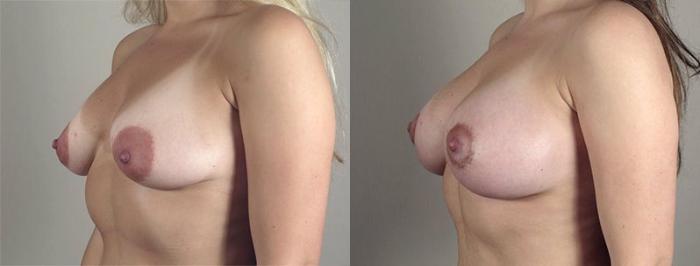 Breast Lift with Implants Case 476 Before & After View #2 | Paramus, New Jersey | Parker Center for Plastic Surgery