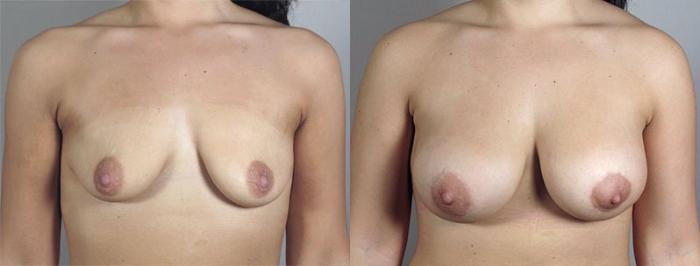 Breast Lift with Implants Case 477 Before & After View #1 | Paramus, New Jersey | Parker Center for Plastic Surgery