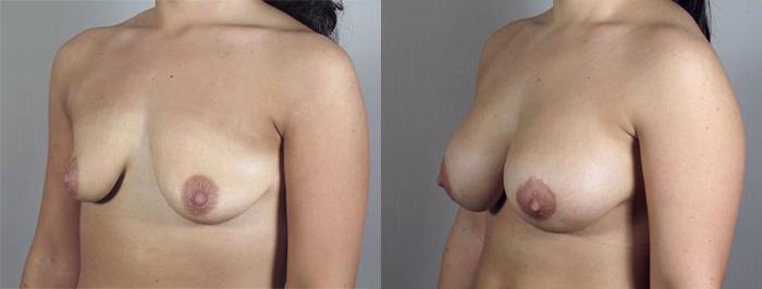 Breast Lift with Implants Case 477 Before & After View #2 | Paramus, New Jersey | Parker Center for Plastic Surgery