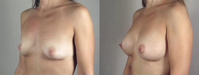 Breast Lift with Implants Case 478 Before & After View #2 | Paramus, New Jersey | Parker Center for Plastic Surgery