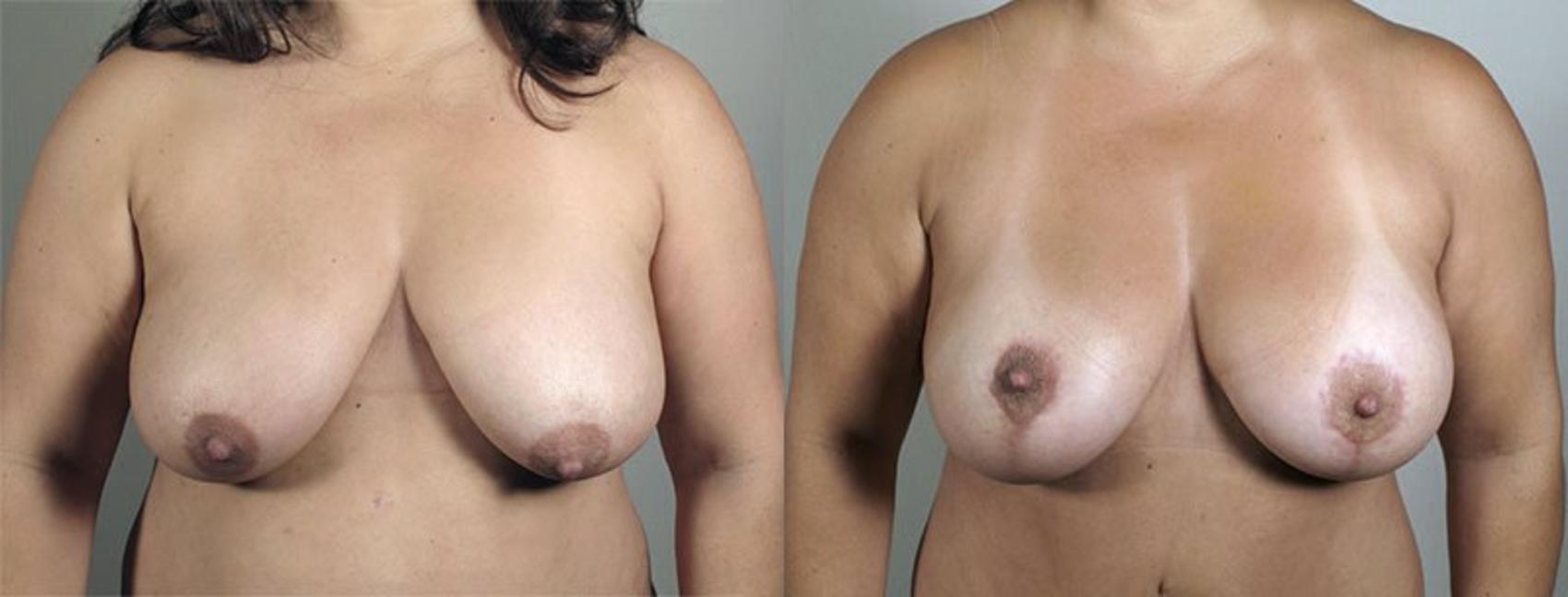 Breast Lift with Implants Case 479 Before & After View #1 | Paramus, New Jersey | Parker Center for Plastic Surgery