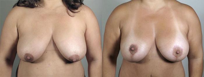 Breast Lift with Implants Case 479 Before & After View #1 | Paramus, New Jersey | Parker Center for Plastic Surgery