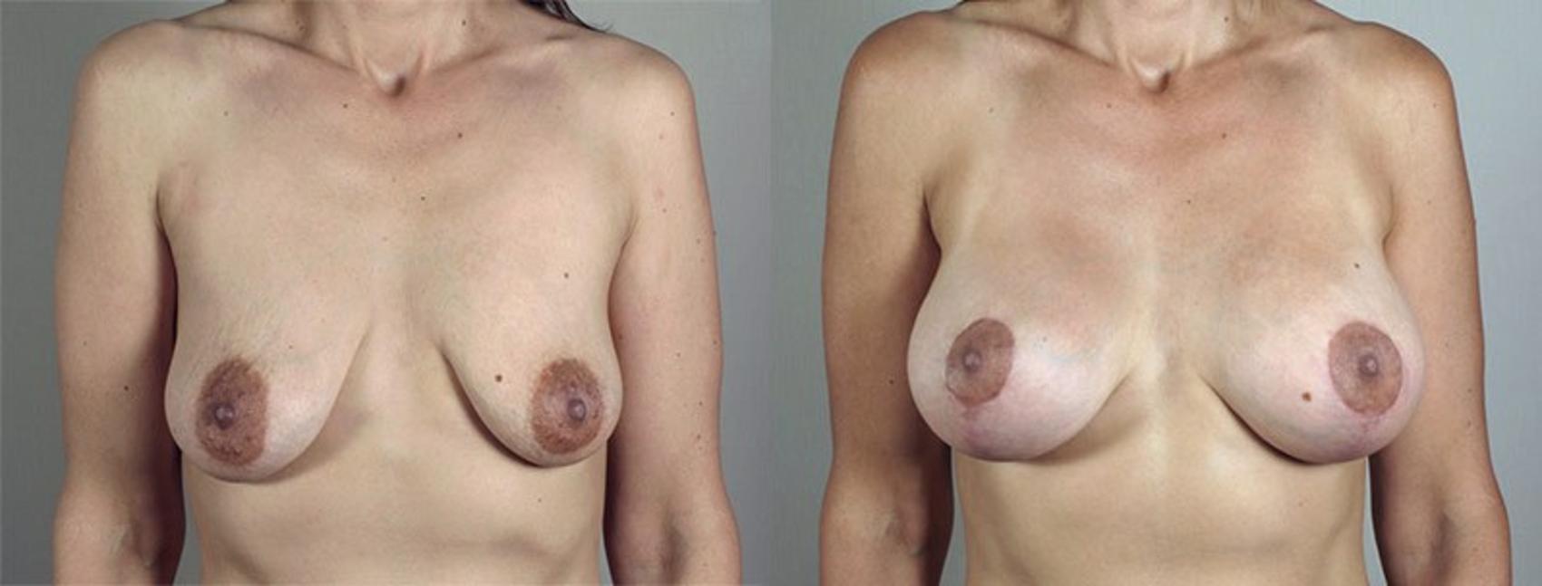 Breast Lift with Implants Case 480 Before & After View #1 | Paramus, New Jersey | Parker Center for Plastic Surgery