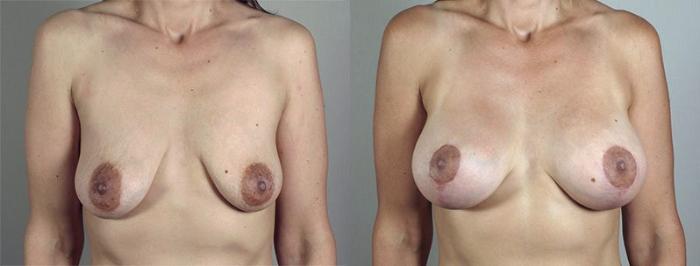 Breast Lift with Implants Case 480 Before & After View #1 | Paramus, New Jersey | Parker Center for Plastic Surgery