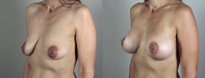 Breast Lift with Implants Case 480 Before & After View #2 | Paramus, New Jersey | Parker Center for Plastic Surgery