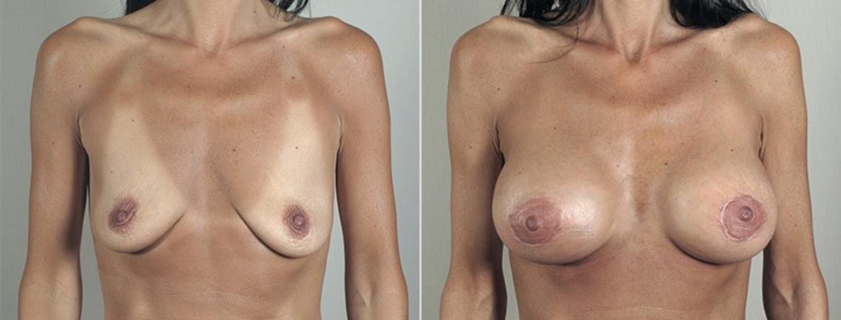 Breast Lift with Implants Case 481 Before & After View #1 | Paramus, New Jersey | Parker Center for Plastic Surgery