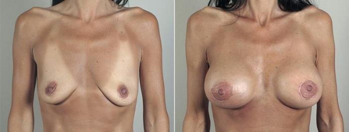Breast Lift with Implants Case 481 Before & After View #1 | Paramus, New Jersey | Parker Center for Plastic Surgery
