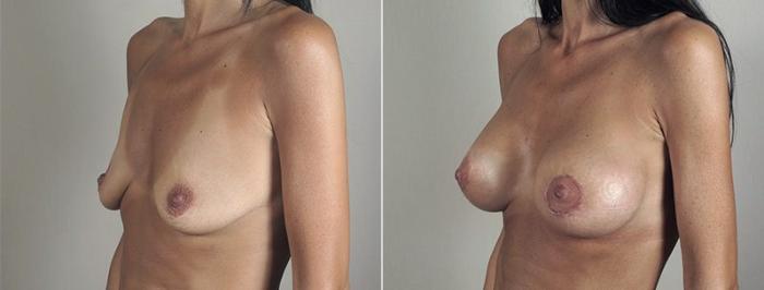 Breast Lift with Implants Case 481 Before & After View #2 | Paramus, New Jersey | Parker Center for Plastic Surgery