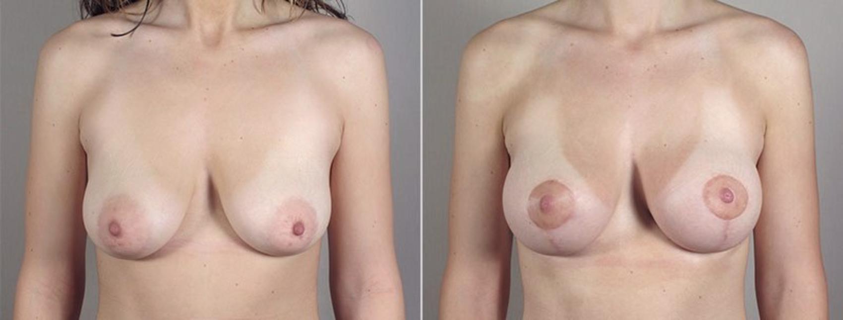 Breast Lift with Implants Case 482 Before & After View #2 | Paramus, New Jersey | Parker Center for Plastic Surgery