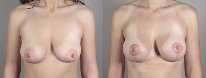 Breast Lift with Implants Case 482 Before & After View #2 | Paramus, New Jersey | Parker Center for Plastic Surgery