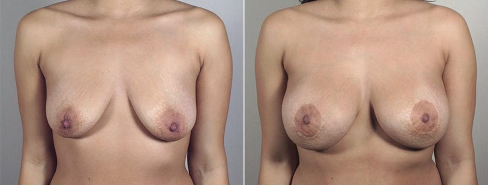 Breast Lift with Implants Case 483 Before & After View #1 | Paramus, New Jersey | Parker Center for Plastic Surgery