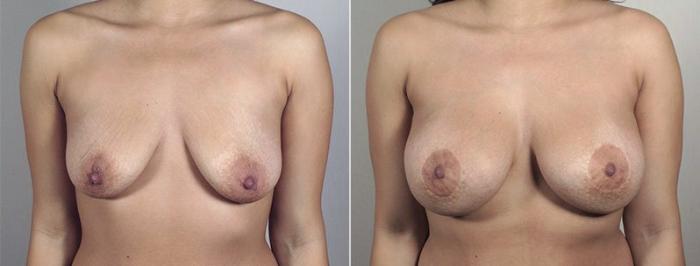 Breast Lift with Implants Case 483 Before & After View #1 | Paramus, New Jersey | Parker Center for Plastic Surgery