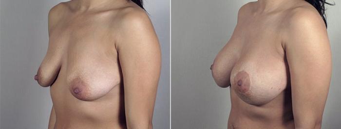 Breast Lift with Implants Case 483 Before & After View #2 | Paramus, New Jersey | Parker Center for Plastic Surgery