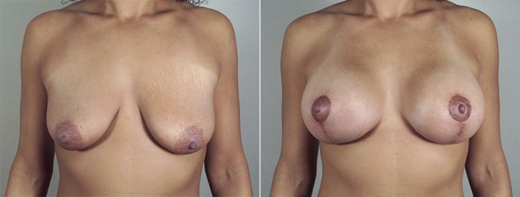 Breast Lift with Implants Case 484 Before & After View #1 | Paramus, New Jersey | Parker Center for Plastic Surgery