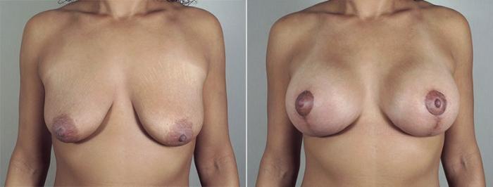 Breast Lift with Implants Case 484 Before & After View #1 | Paramus, New Jersey | Parker Center for Plastic Surgery