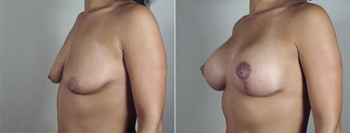 Breast Lift with Implants Case 484 Before & After View #2 | Paramus, New Jersey | Parker Center for Plastic Surgery