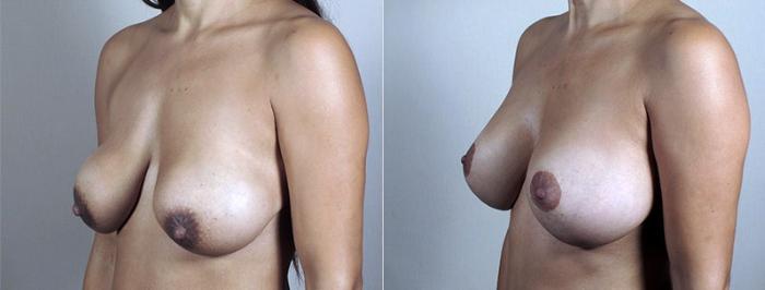 Breast Lift with Implants Case 485 Before & After View #2 | Paramus, New Jersey | Parker Center for Plastic Surgery