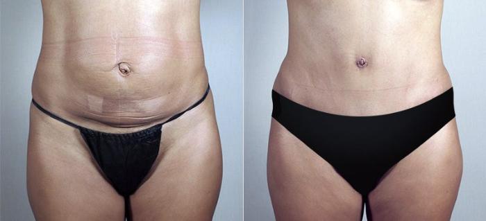Breast Lift with Implants Case 485 Before & After View #3 | Paramus, New Jersey | Parker Center for Plastic Surgery