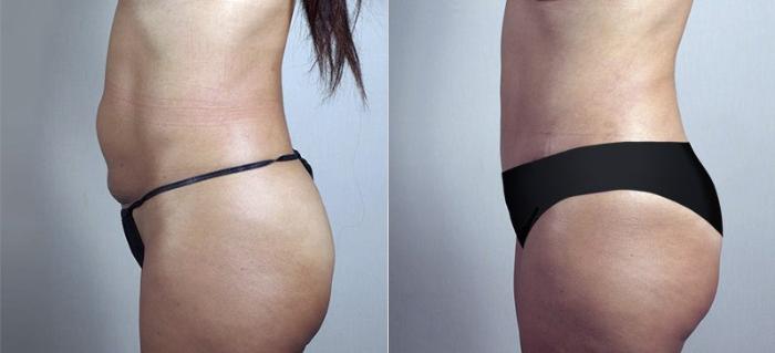 Breast Lift with Implants Case 485 Before & After View #4 | Paramus, New Jersey | Parker Center for Plastic Surgery