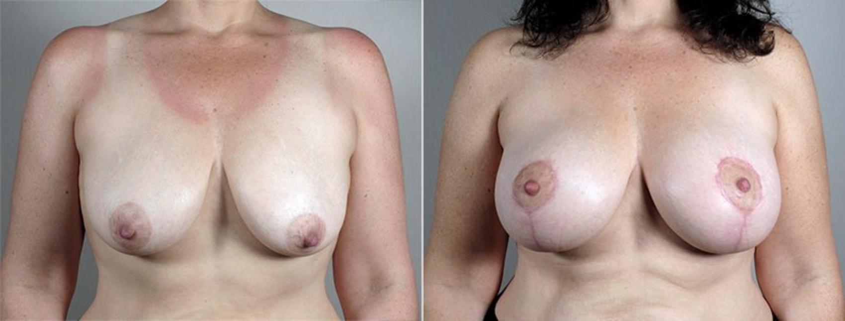 Breast Lift with Implants Case 486 Before & After View #1 | Paramus, New Jersey | Parker Center for Plastic Surgery