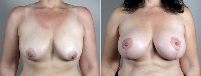 Breast Lift with Implants Case 486 Before & After View #1 | Paramus, New Jersey | Parker Center for Plastic Surgery