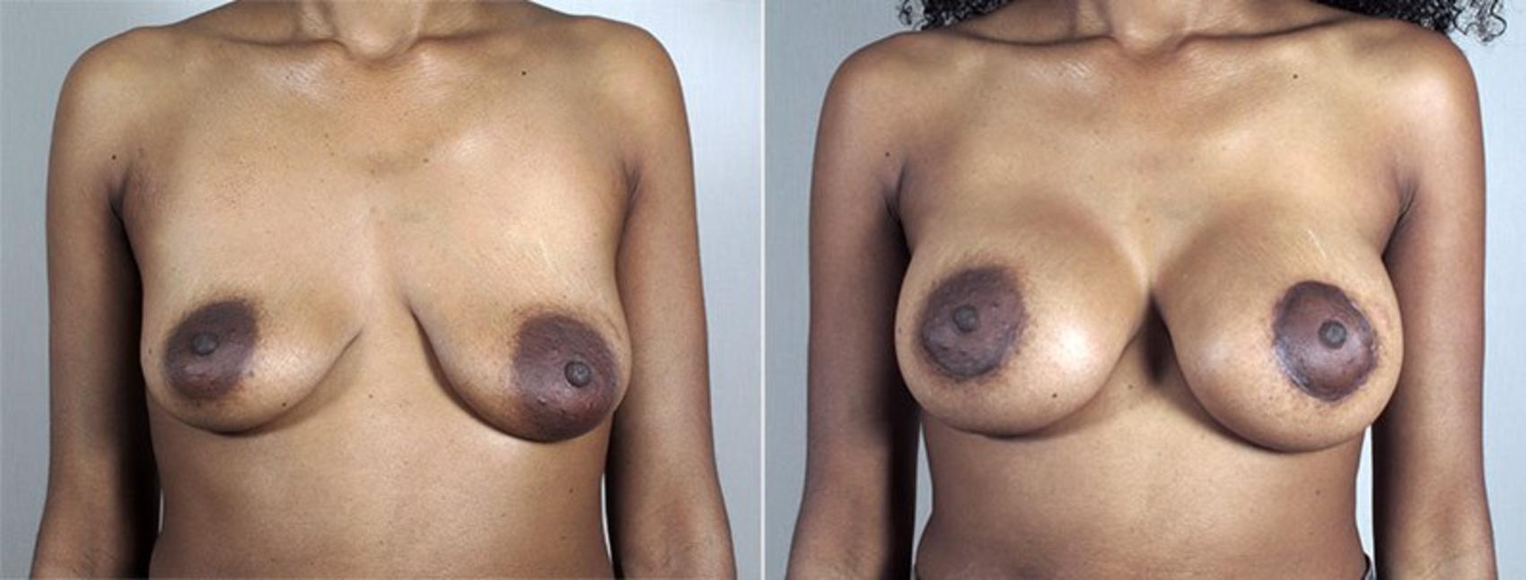 Breast Lift with Implants Case 487 Before & After View #1 | Paramus, New Jersey | Parker Center for Plastic Surgery