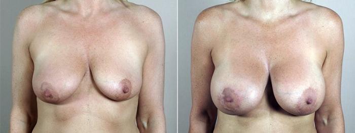 Breast Lift with Implants Case 488 Before & After View #1 | Paramus, New Jersey | Parker Center for Plastic Surgery
