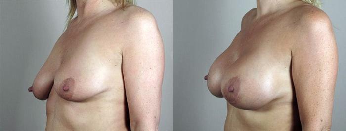 Breast Lift with Implants Case 488 Before & After View #2 | Paramus, New Jersey | Parker Center for Plastic Surgery
