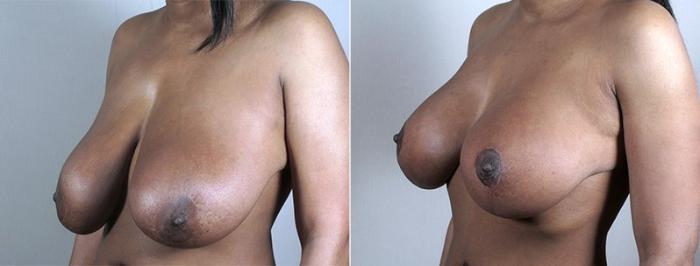 Breast Lift with Implants Case 489 Before & After View #1 | Paramus, New Jersey | Parker Center for Plastic Surgery