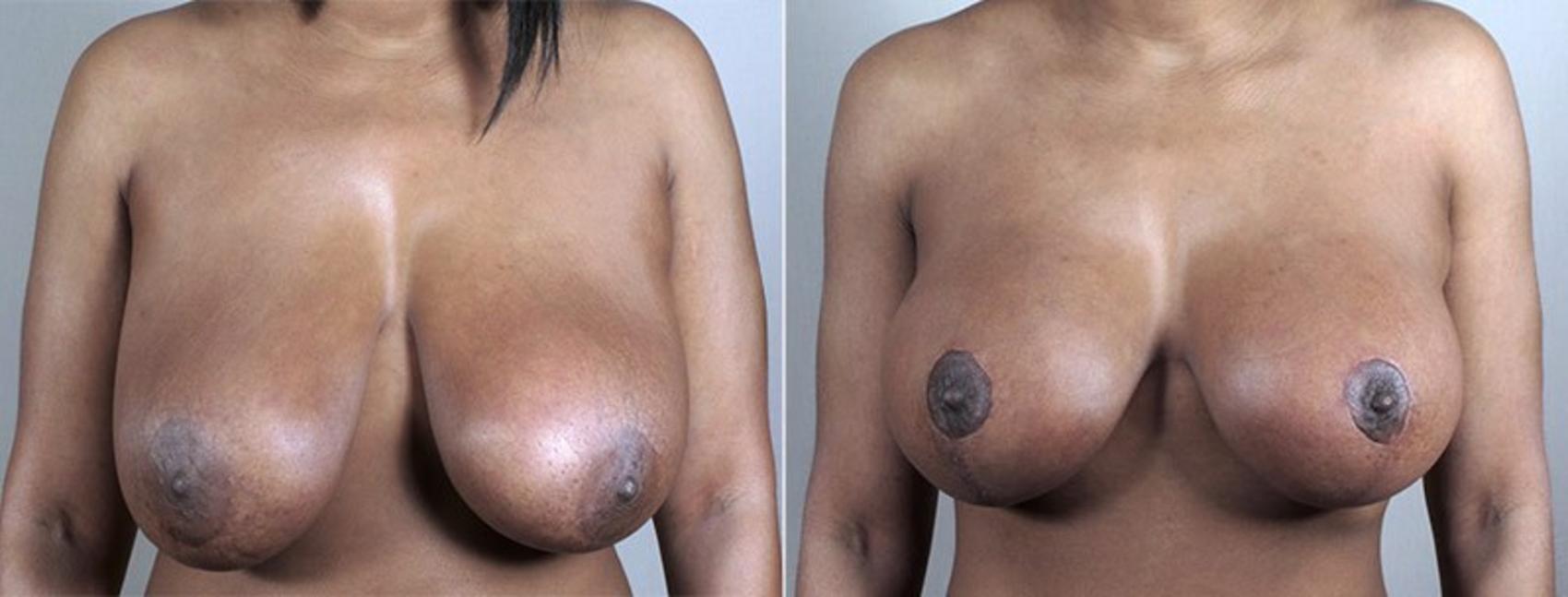 Breast Lift with Implants Case 489 Before & After View #2 | Paramus, New Jersey | Parker Center for Plastic Surgery