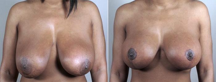Breast Lift with Implants Case 489 Before & After View #2 | Paramus, New Jersey | Parker Center for Plastic Surgery