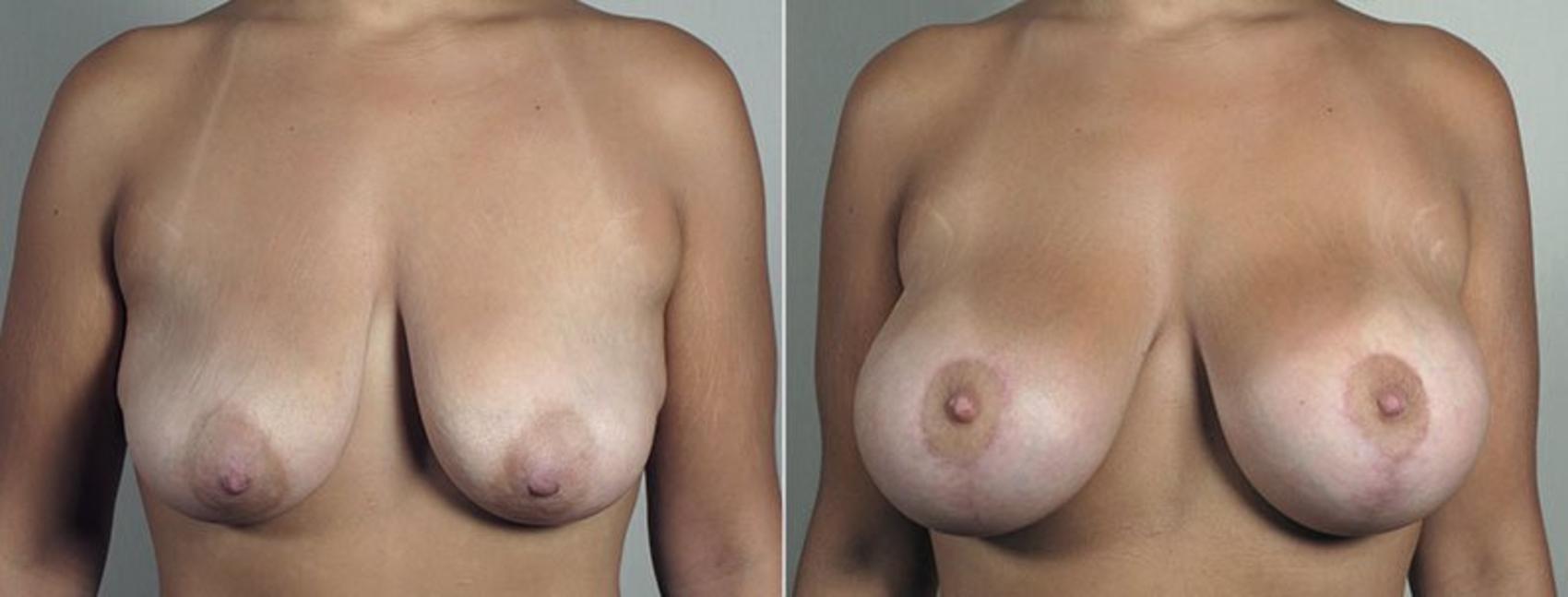 Breast Lift with Implants Case 491 Before & After View #1 | Paramus, New Jersey | Parker Center for Plastic Surgery