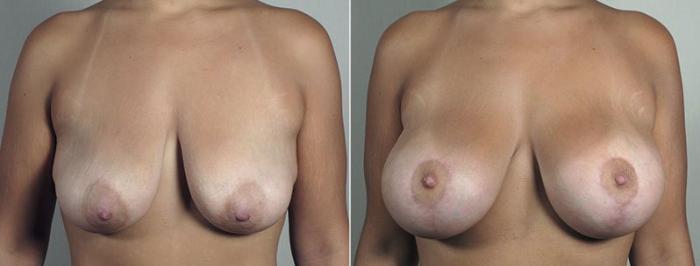 Breast Lift with Implants Case 491 Before & After View #1 | Paramus, New Jersey | Parker Center for Plastic Surgery