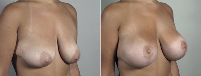 Breast Lift with Implants Case 491 Before & After View #2 | Paramus, New Jersey | Parker Center for Plastic Surgery