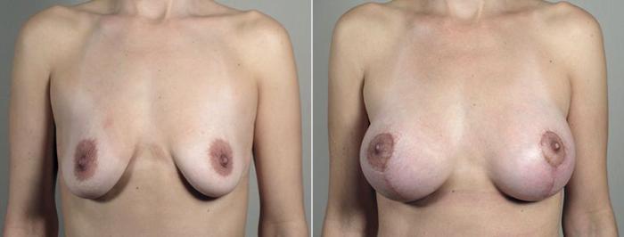 Breast Lift with Implants Case 492 Before & After View #1 | Paramus, New Jersey | Parker Center for Plastic Surgery