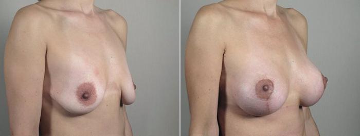 Breast Lift with Implants Case 492 Before & After View #2 | Paramus, New Jersey | Parker Center for Plastic Surgery