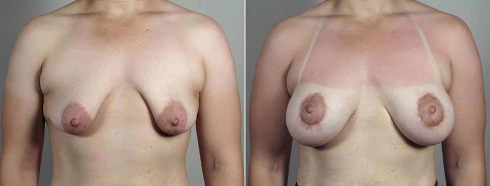 Breast Lift with Implants Case 493 Before & After View #1 | Paramus, New Jersey | Parker Center for Plastic Surgery