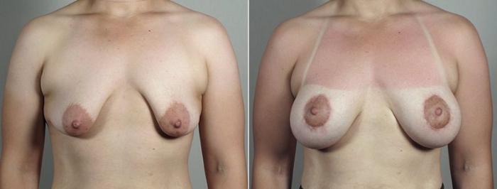 Breast Lift with Implants Case 493 Before & After View #1 | Paramus, New Jersey | Parker Center for Plastic Surgery